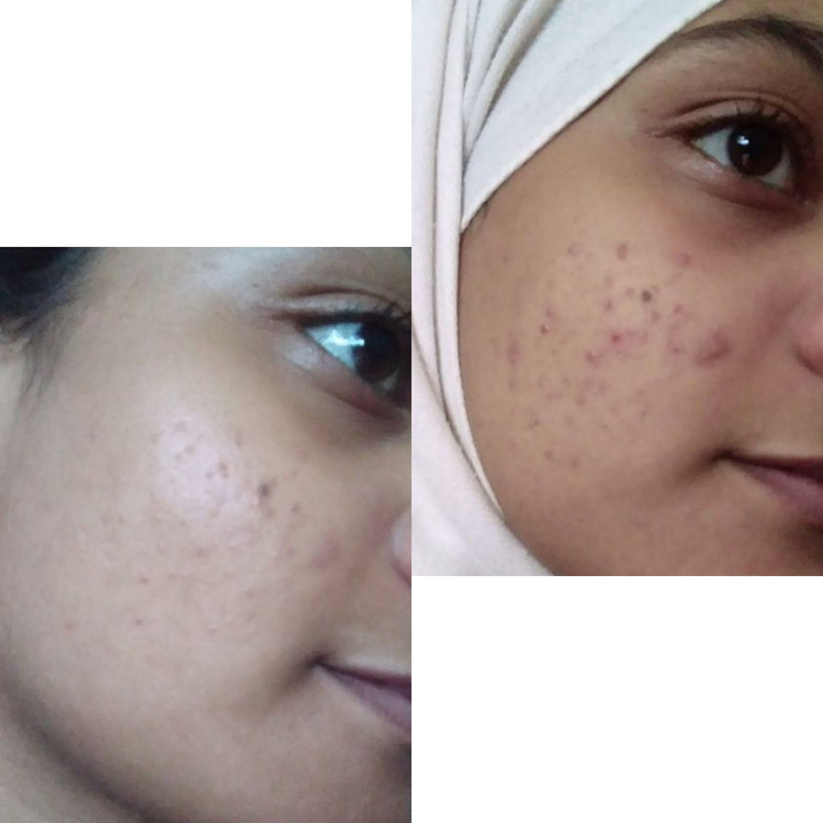 لوسیون ضدجوش و کنترل کننده چربی صورت ماسکانی